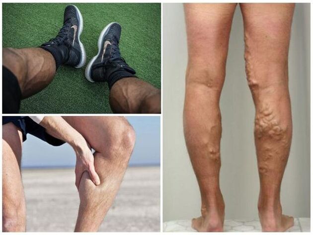 seperti apa varises di kaki pria