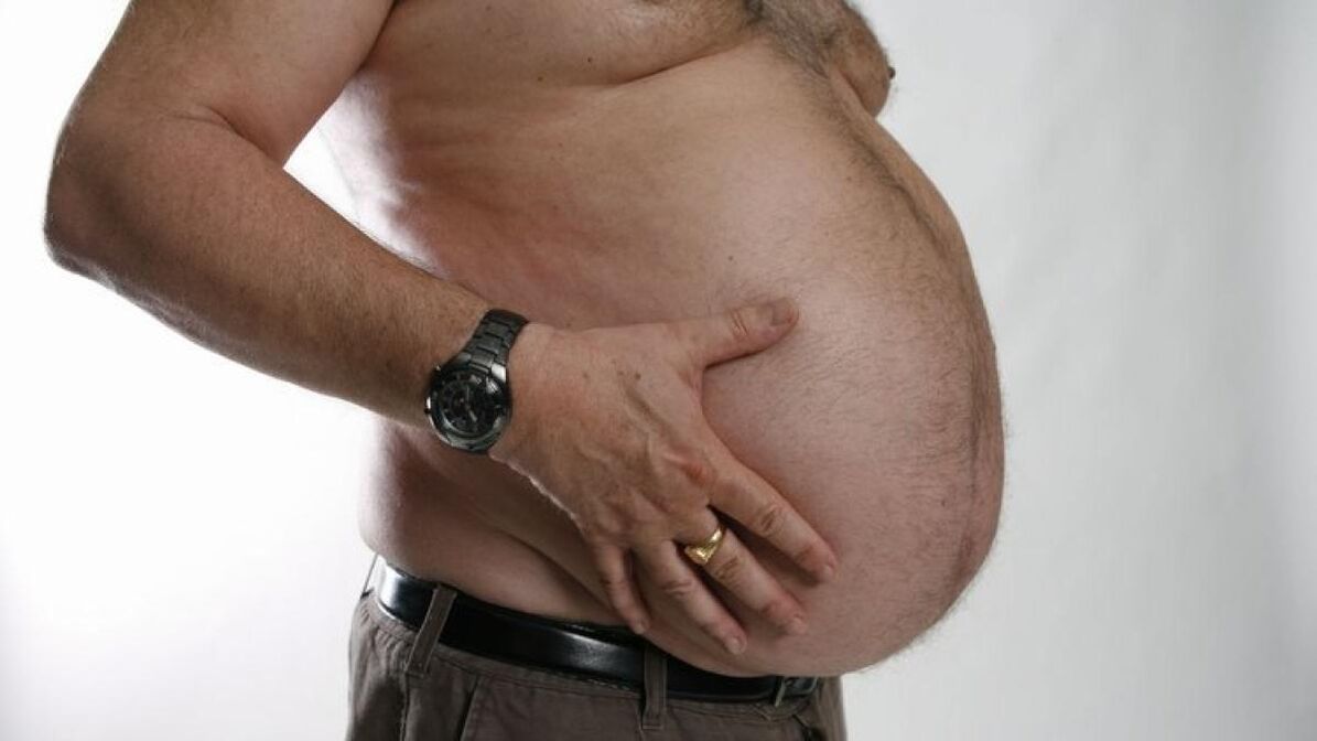 obesitas sebagai penyebab perkembangan varises