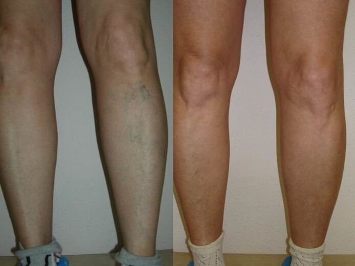 kaki sebelum dan sesudah perawatan laser varises