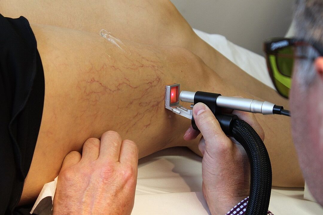 Koagulasi laser