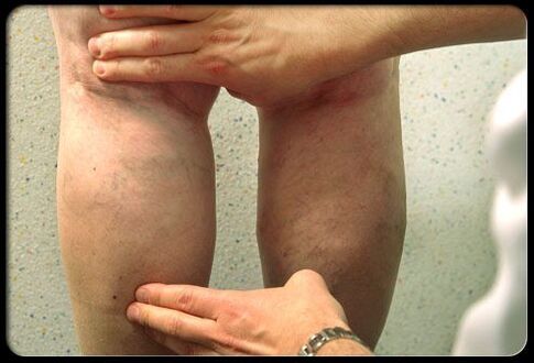 Dokter memeriksa kaki dengan varises