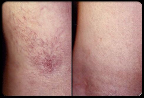 Sebelum dan sesudah sclerotherapy